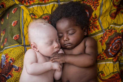 Gemelo Albino con su hermano en Congo