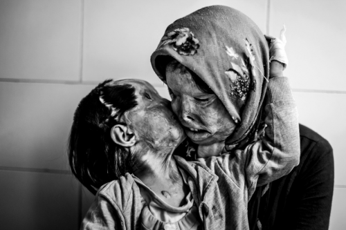 Madre e Hija de 3 años - victimas de ataque acido